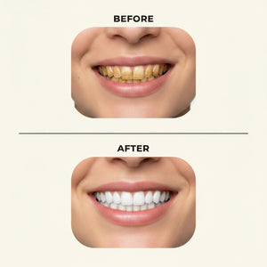 Snap-On Veneers