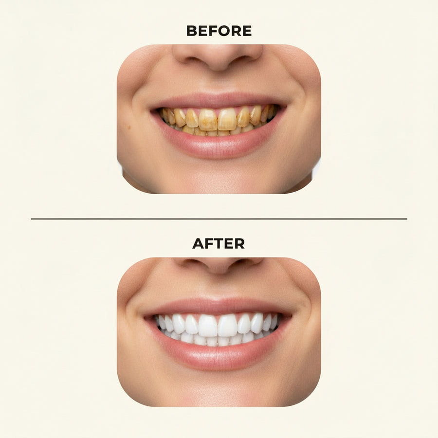 Snap-On Veneers